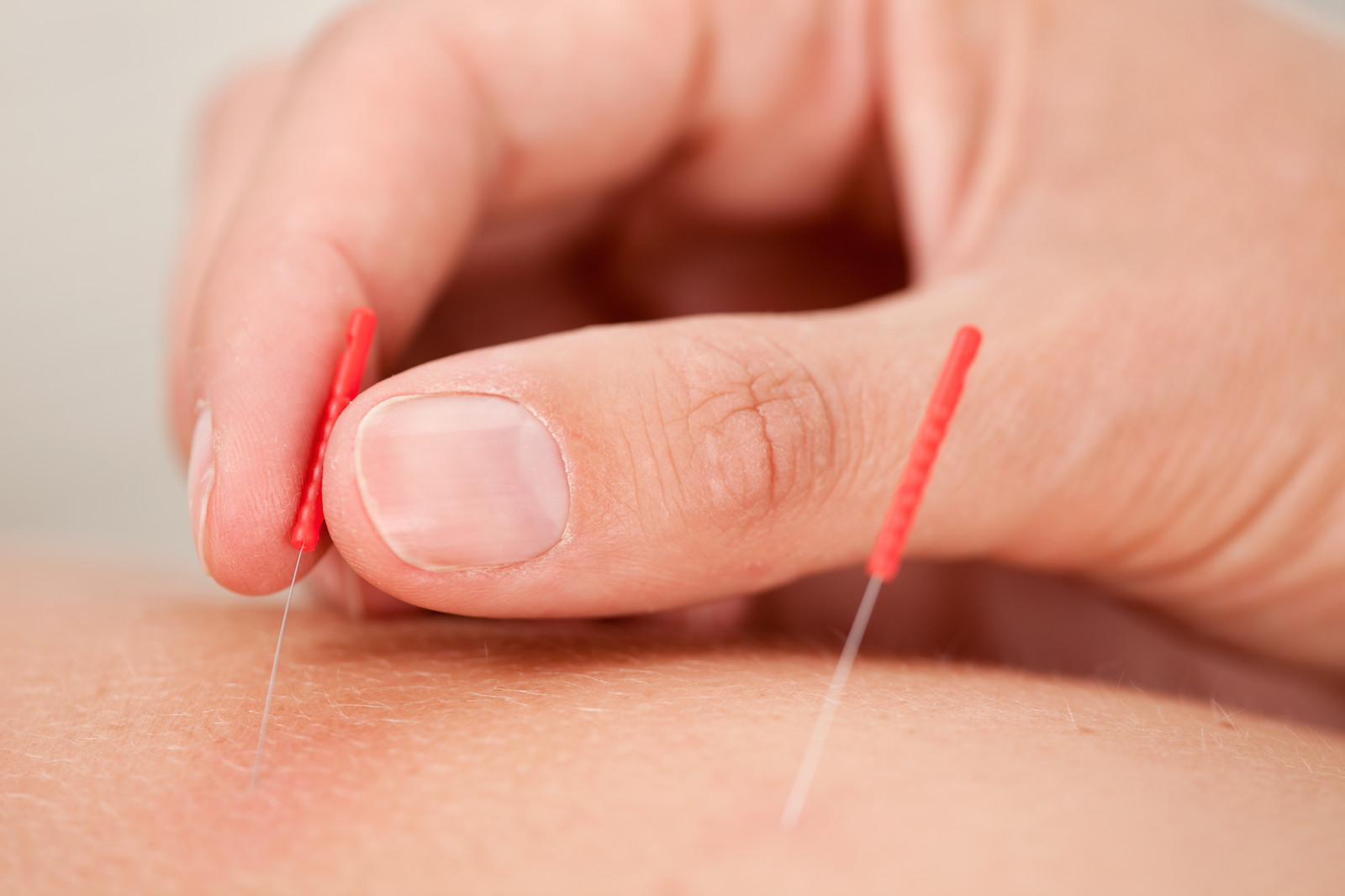 General Health Acupuncture