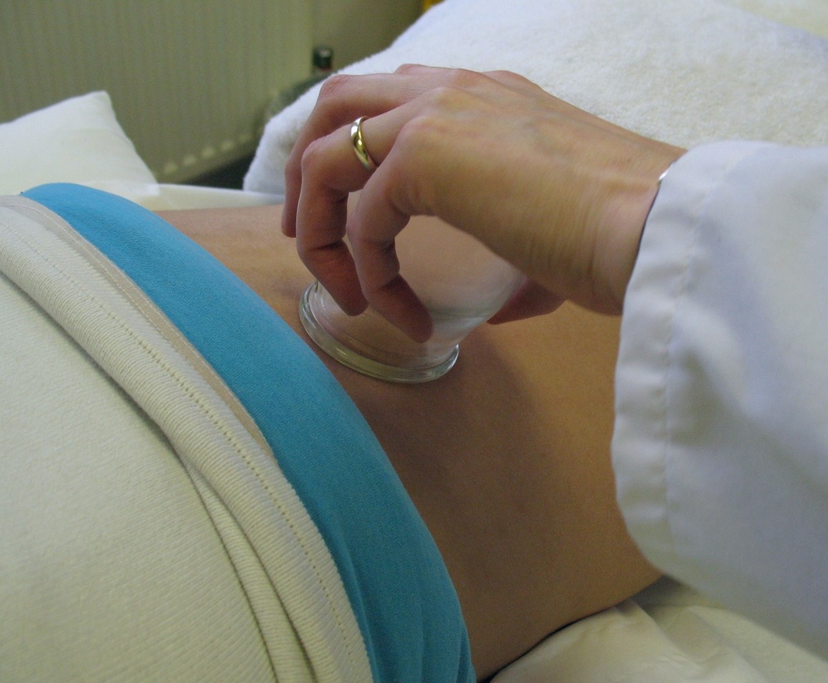 Fertility Acupuncture