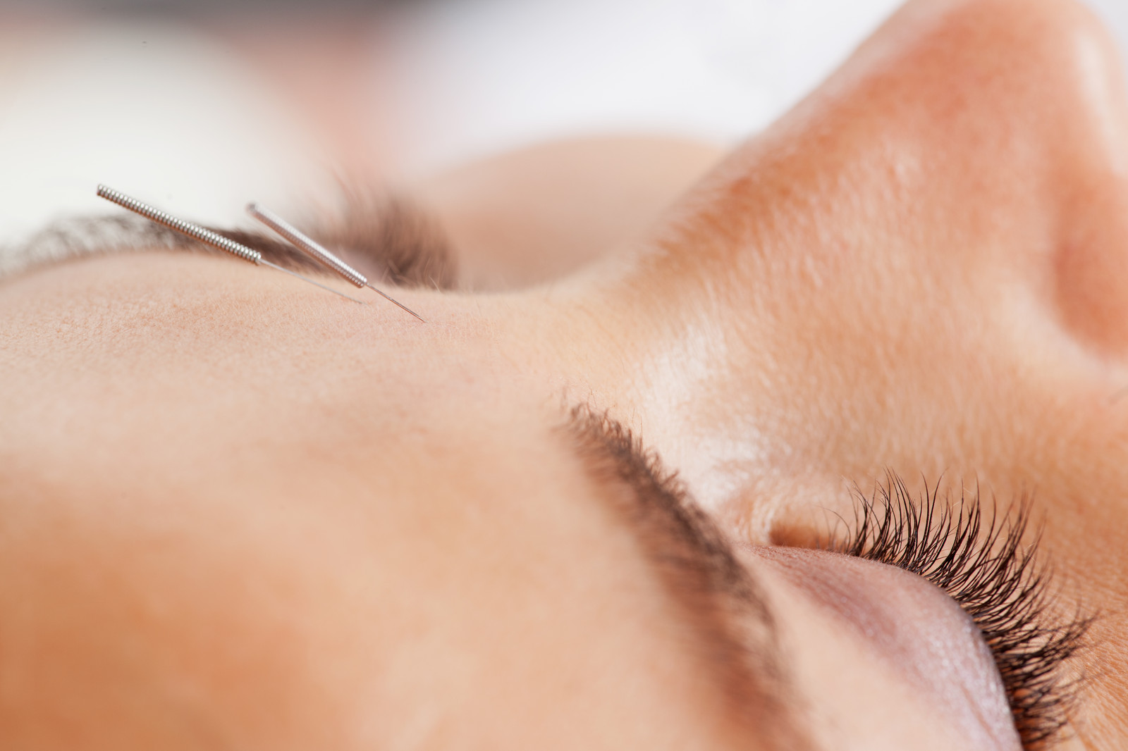 Pregnancy Acupuncture
